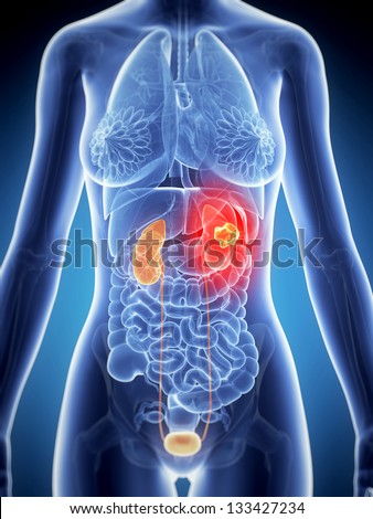 3d rendered illustration of female kidney cancer 3d rendered illustration of female kidney cancer