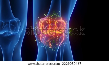 3D rendered Medical Illustration of Male Anatomy - Inflamed Knee undergoing Healing. Plain Black Background. Left side Foto d'archivio © 