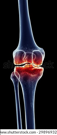 medically accurate illustration - painful knee