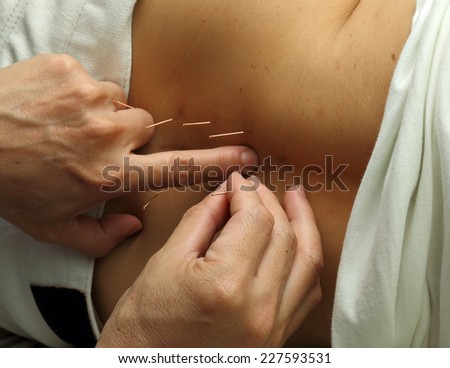 Acupuncture specialist doctor inserting needle into patient back for pain treatment