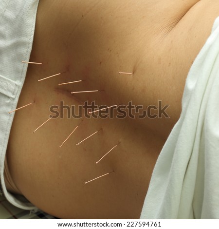 Acupuncture specialist doctor inserted needle into patient back for pain treatment