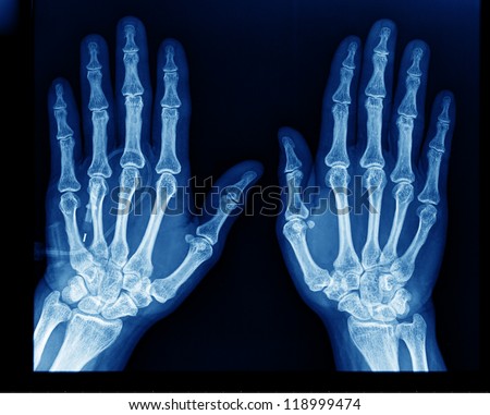 X-Ray Hand