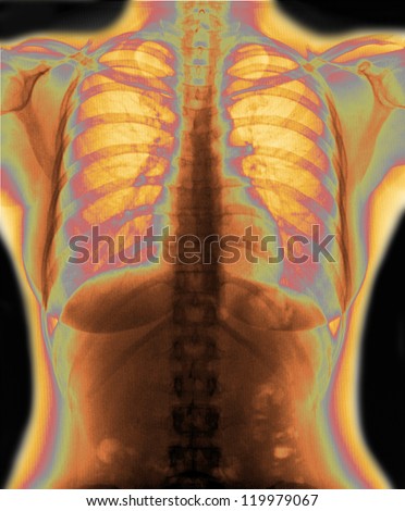 X-Ray Image Of Woman Chest for a medical diagnosis