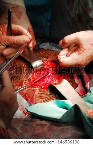 ASHKELON, ISR - AUG 06:Tools and hands of surgeon at work in operating room on Aug 06 2008. At least 7 million patients annually may have post-operative complications.