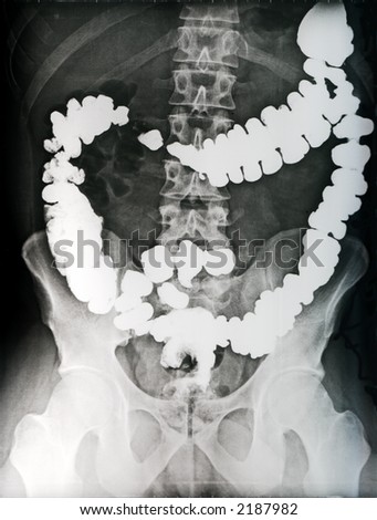 Abdomen Radiography With Contrasted Intestine Stock Photo 2187982 ...