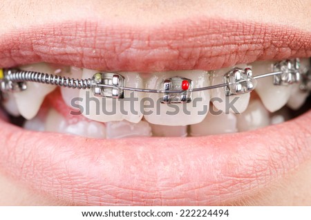 Mouth with brackets braces in medical concept