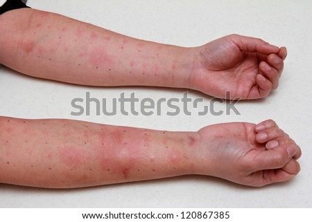 Positive Allergy Skin Test in a Male Patient