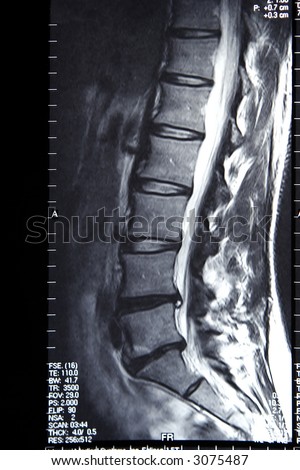 Mri Of Lower Back Stock Photo 3075487 : Shutterstock