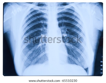 Blue X-Ray Picture Of Lungs Stock Photo 65510230 : Shutterstock