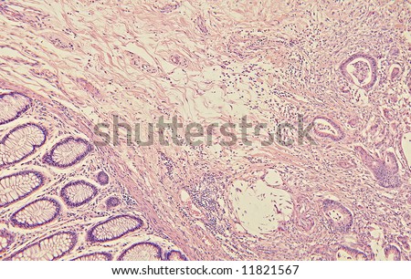 Real photomicrograph panorama of Colon Cancer, taken through my microscope. Shallow DOF