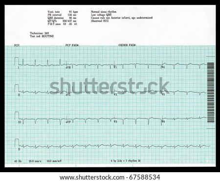 A Real Ekg Shows An Abnormal Result. Stock Photo 67588534 : Shutterstock