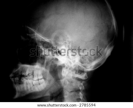 Human X-ray picture (head bones)