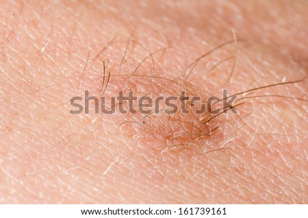 Hairy skin tag on a persons skin close up