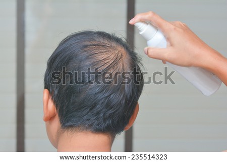 The Man is spray treatment for lose one\'s hair, bald head