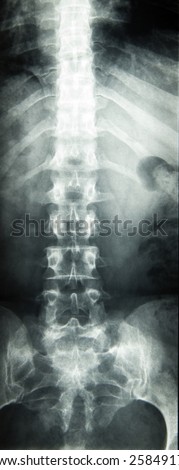 X-ray of the spinal column and pelvis of a woman