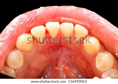 Clean teeth after professional dental hygiene treatment.