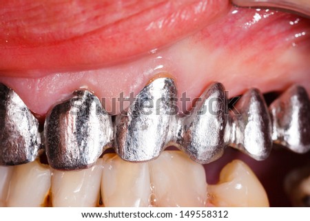 Metal basis ceramic dental bridge in mouth.