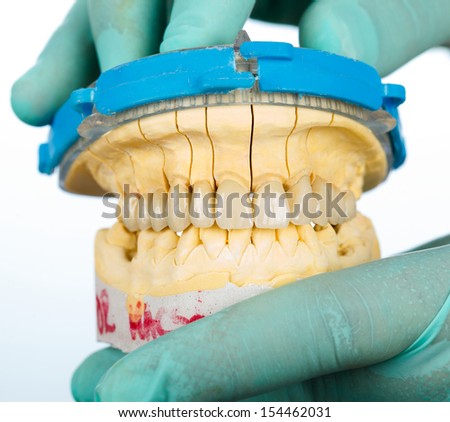 Porcelain teeth - dental bridge