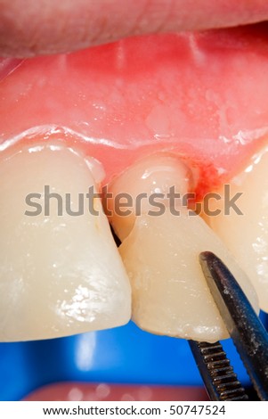 Resin crown for temporary treatment, that are used in cases when the patient has to walk away with buffed teeth from the dentist. These have protective role on teeth, with less regard on aestetics.
