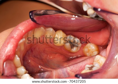 A photograph with the posterior lower molar teeth, one premolar with crown, cavities, fillings and plaque - taken with a special photography technique, with dental mirror.