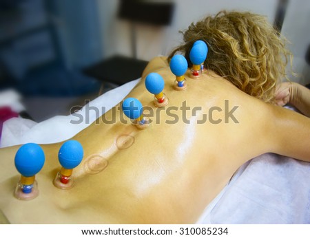 Cupping therapy. Cups from the patient\'s back