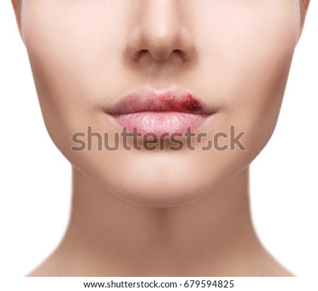 Plump Female Lips With Herpes Sore Isolated On White Ez Canvas