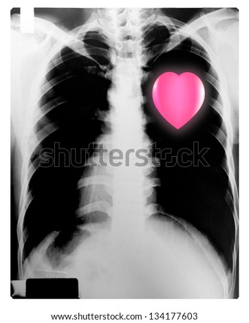 X-Ray Image Of Human Chest with a pink heart