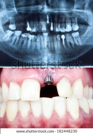 A macro shot of dental implant in the oral cavity and its Panoramic dental X-Ray