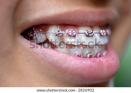 smile with pink braces (shallow DOF as fous is on the 2nd tooth from right)