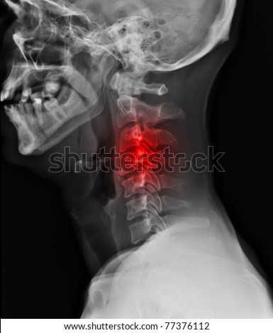 X-ray of painful neck  / Many others X-ray images in my portfolio.
