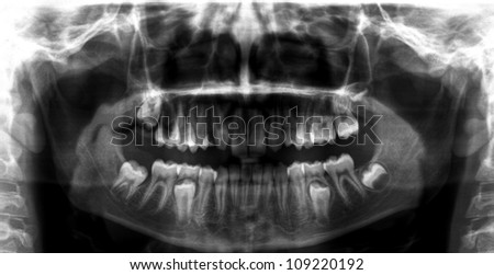 Panoramic dental X-Ray - MRI