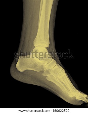 Left foot MRI - X-ray resonance - Medical Image