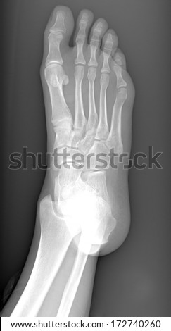 Left foot MRI, patient\'s data cloned out.