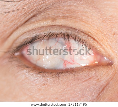 close up of the blind eye during eye examination.