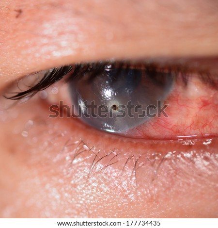 Close up of the metallic foreign body on cornea during eye examination.