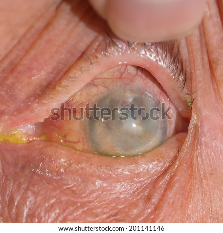 Close up of the blind eye during eye examination.