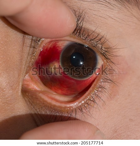 Close up of the large sub conjunctival heamorrhage during eye examination.