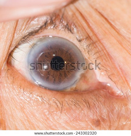 Close up of the  cataract during eye examination.