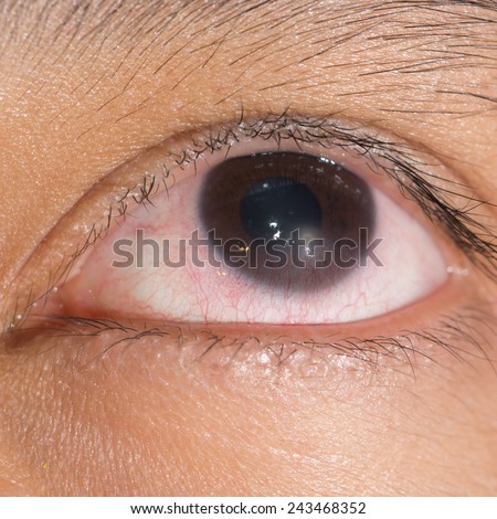 Close up of the linbal stem cell deficiency during eye examination.