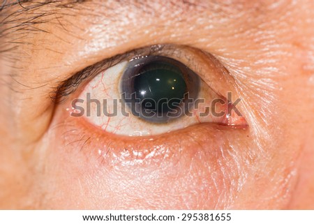 Close up of the dilated pupil eye during eye examination.