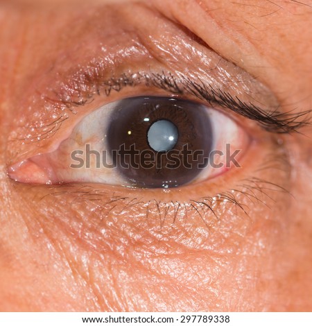 close up of the senile cataract during eye examination.