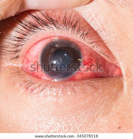 Royalty Free Close Up Of Acute Viral Conjunctivitis 345078503