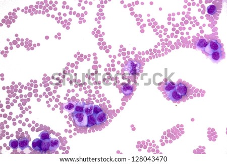 Blood smear to show myelomonocytic leukemia. The smear shows large number of cancer leukemia cells (large blue cells) with the smaller red to pink normal red blood cells or erythrocytes.