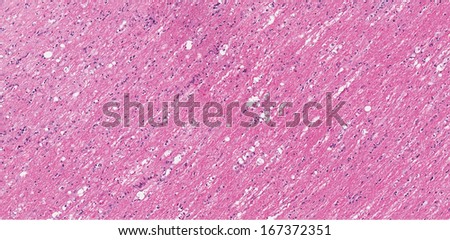 Spinal Cord Degeneration with wallerian degeneration of nerve fibers. Axonal degeneration of spinal cord with digestion chambers with vacuolation of white matter.