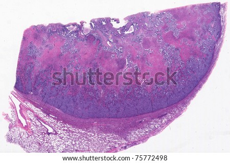 Microscopic view of lung cancer showing normal compressed lung (bottom left) and excised  cancer on the top replacing normal lung tissue. There is necrosis (dead tissue) in the cancer.