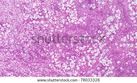 Cryptococcus (fungal) infection of the nose