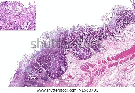 Severe Case Of Protozoan And Bacterial Enteritis. The Inset Shows ...