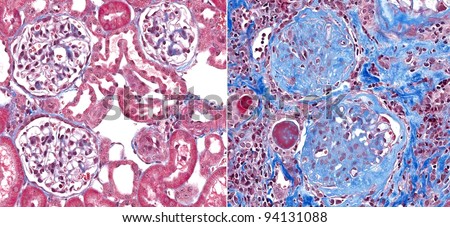 Normal healthy glomeruli (left) with glomerulosclerosis (right) a condition with fibrosis (scar) of the glomeruli (blue stain). The thin loops of blood vessels are replaced by the blue scar tissue.
