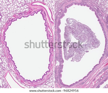 Acute Bronchitis. Inflammation Of The Bronchi (Right) With The Airway ...