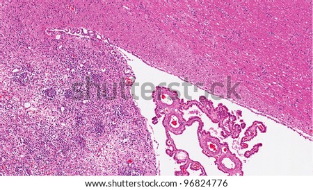 Metastasis of lymphoma to the brain (bottom left). The small blue tumor cells are clustered around blood vessels. Choroid plexus (middle) of the ventricle and unaffected brain (top right) are present